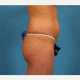 25-34 year old woman treated with Brazilian Butt Lift before 3093503