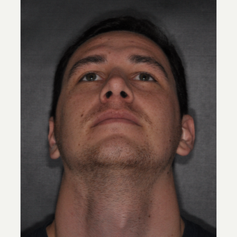 18-24 year old man treated with Rhinoplasty 6 weeks post-op after 3499622