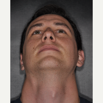 18-24 year old man treated with Rhinoplasty 6 weeks post-op before 3499622