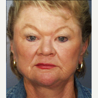 65-74 year old woman treated with Laser Resurfacing after 3711320