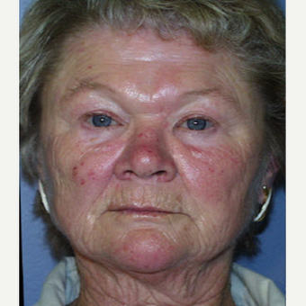 65-74 year old woman treated with Laser Resurfacing before 3711320