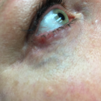 35-44 year old woman treated with Vein Treatment before 3079388