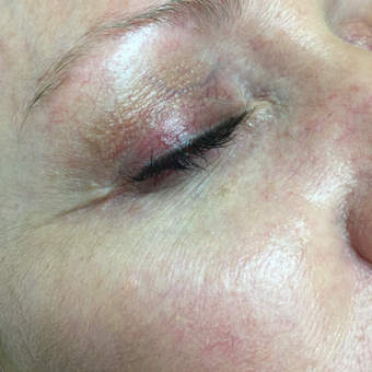 35-44 year old woman treated with Vein Treatment after 3079388