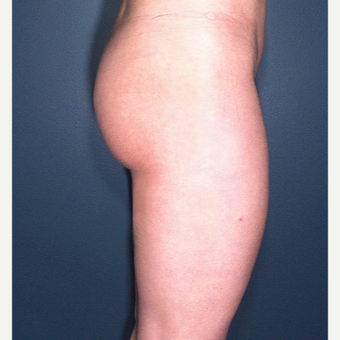25-34 year old woman treated with Liposuction after 3664508