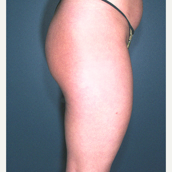 25-34 year old woman treated with Liposuction before 3664508
