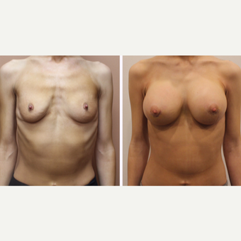 25-34 year old woman treated with Breast Augmentation before 3333316
