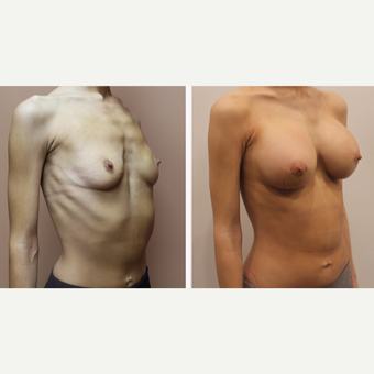 25-34 year old woman treated with Breast Augmentation after 3333316