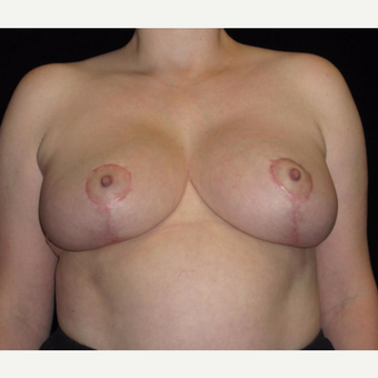 41 year old woman treated with Breast Lift after 3026035