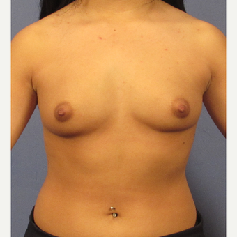 25-34 year old woman treated with Breast Augmentation before 3077094
