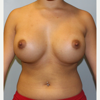 25-34 year old woman treated with Breast Augmentation after 3077094