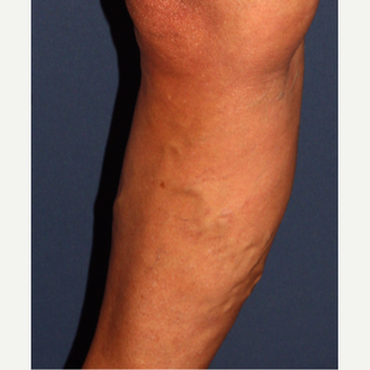 45-54 year old woman treated with Sclerotherapy before 3244568