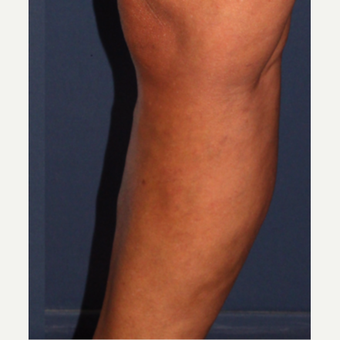 45-54 year old woman treated with Sclerotherapy after 3244568