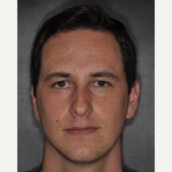 18-24 year old man treated with Septoplasty 6 weeks post-op before 3499633