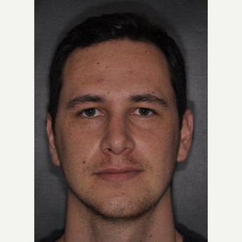 18-24 year old man treated with Septoplasty 6 weeks post-op after 3499633