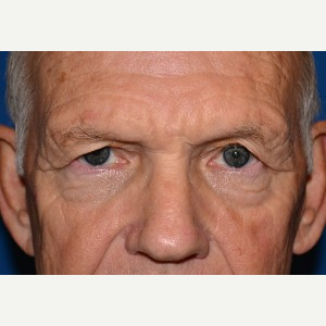 65-74 year old man treated with Brow Lift before 3388567