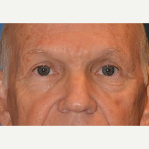 65-74 year old man treated with Brow Lift after 3388567