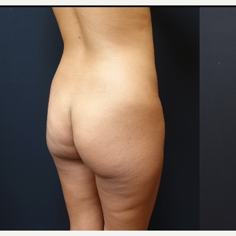 25-34 year old woman treated with Liposculpture before 3731902