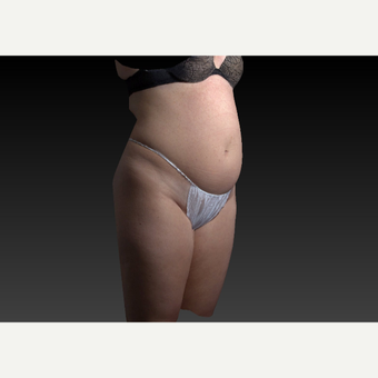 35-44 year old woman treated with Smart Lipo before 3803870