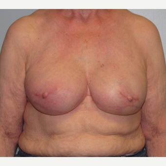 77 year old woman treated with Tissue Expander/Implant Breast Reconstruction after 3097651