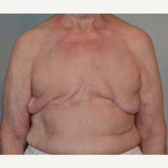 77 year old woman treated with Tissue Expander/Implant Breast Reconstruction before 3097651