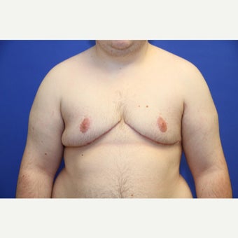 23 year old trans man treated with FTM Chest Masculinization Surgery after 2176308