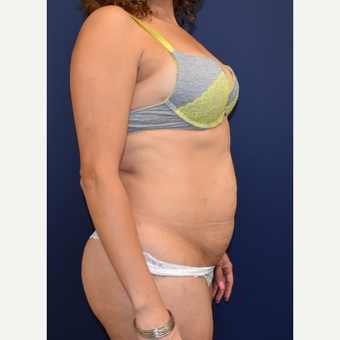 35-44 year old woman treated with Liposuction before 3213949