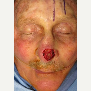 55-64 year old man treated with Mohs Surgery before 3389235