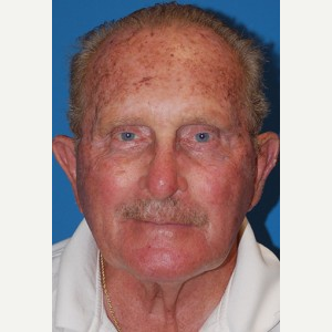 55-64 year old man treated with Mohs Surgery after 3389235