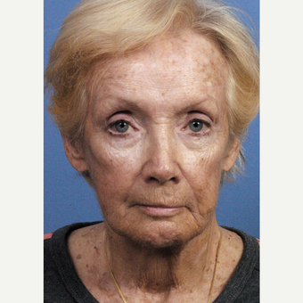 75 and up year old woman treated with Chemical Peel before 3761450