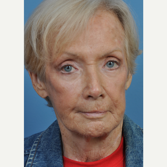 75 and up year old woman treated with Chemical Peel after 3761450