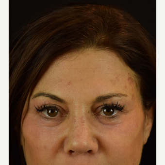 Eye Opener - Upper Lid Blepharoplasty with Laser Resurfacing after 3523763