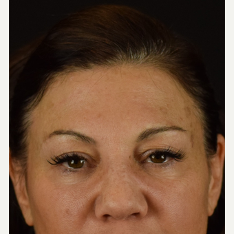 Eye Opener - Upper Lid Blepharoplasty with Laser Resurfacing before 3523763
