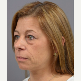 35-44 year old woman treated with Eyelid Surgery, Fat Transfer & TCA Chemical Peel before 3060762