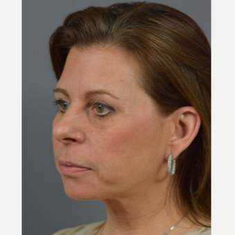 35-44 year old woman treated with Eyelid Surgery, Fat Transfer & TCA Chemical Peel after 3060762