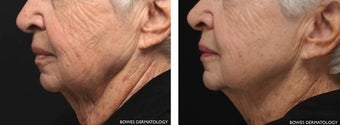 Evolastin Non-Surgical Neck Lift 1034966