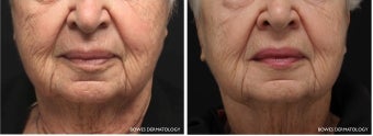 Evolastin Non-Surgical Neck Lift before 1034966