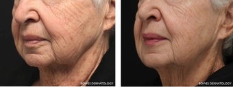 Evolastin Non-Surgical Neck Lift after 1034966