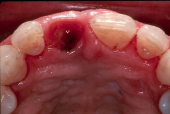 Gum Graft Around Implant after 957138