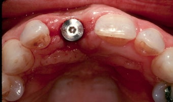 Gum Graft Around Implant before 957138