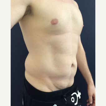 35-44 year old man treated with Mini Tummy Tuck and Liposuction chest, waist, back before 3848435