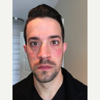 25-34 year old man treated with Voluma (mid face) and Belotero (tear trough) 1618193