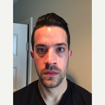 25-34 year old man treated with Voluma (mid face) and Belotero (tear trough) 1618193