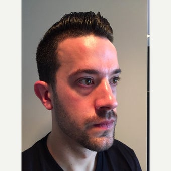 25-34 year old man treated with Voluma (mid face) and Belotero (tear trough) before 1618193