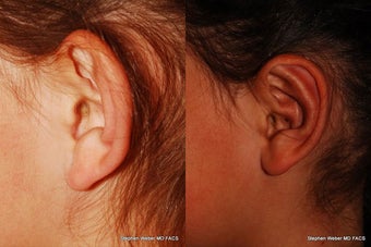 Ear Surgery before 1445759