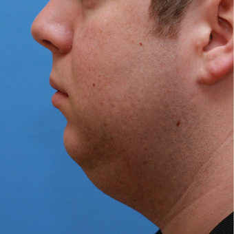 Young gentleman wished better neck definition before 3383666