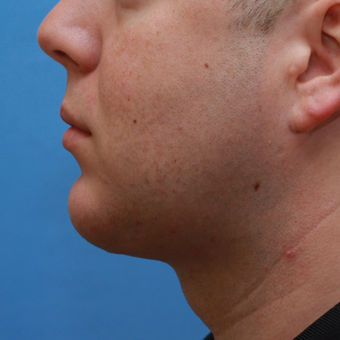 Young gentleman wished better neck definition after 3383666