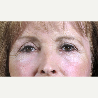 55-64 year old woman treated with Eyelid Surgery after 3213286