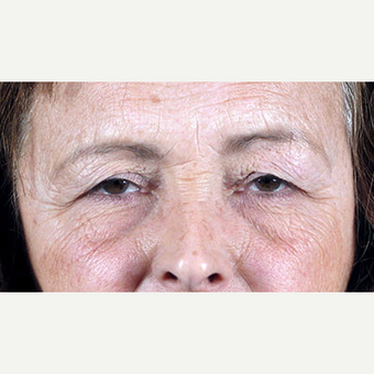 55-64 year old woman treated with Eyelid Surgery before 3213286
