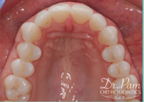 45-54 year old woman treated with Lingual Braces after 3498165