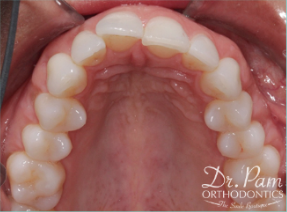 45-54 year old woman treated with Lingual Braces before 3498165
